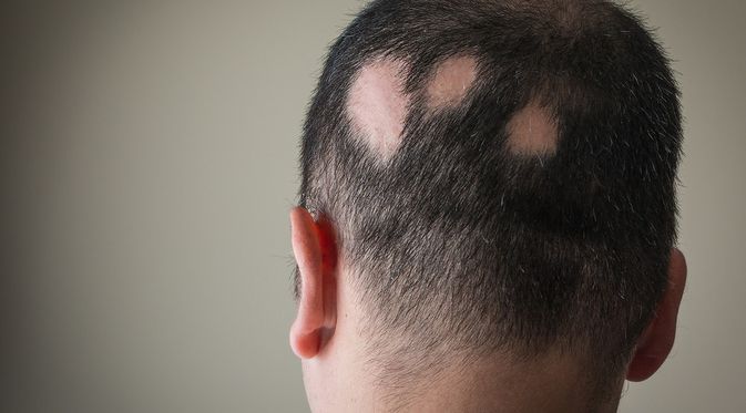 Penyakit Alopecia Areata (Alex Pap/Shutterstock)
