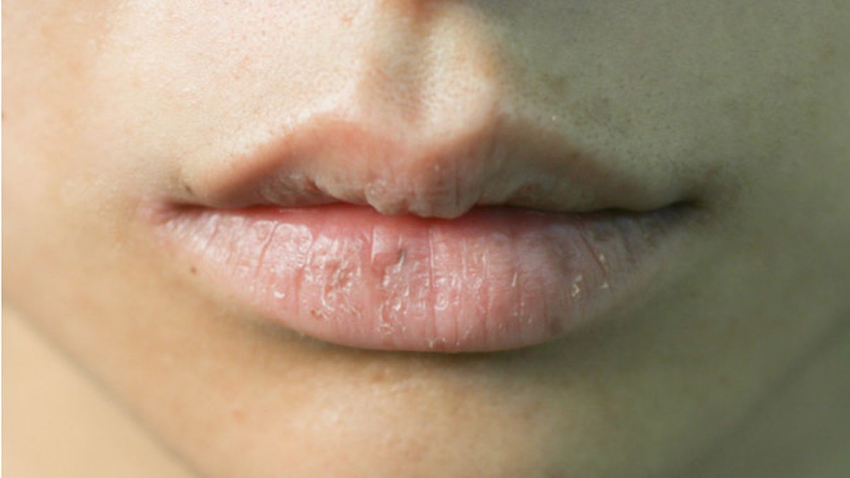 cara merawat bibir pecah