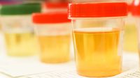 Penyebab Urine Berwarna Kuning Setelah Minum Vitamin