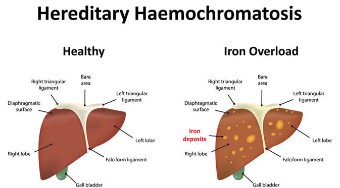 Hemokromatosis