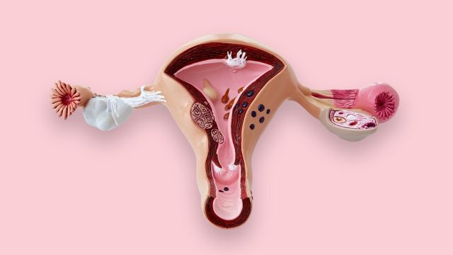 cara menghilangkan kista pada rahim