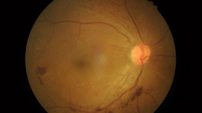 szem és látás myopia hyperopia hyperthyreosisos látás