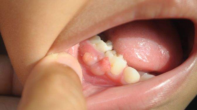 kenapa gigi sakit dan gusi bengkak 11