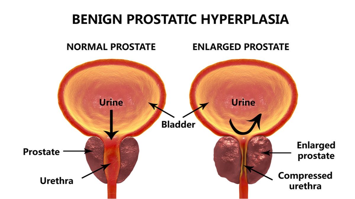benigna hiperplazija prostate simptomi)