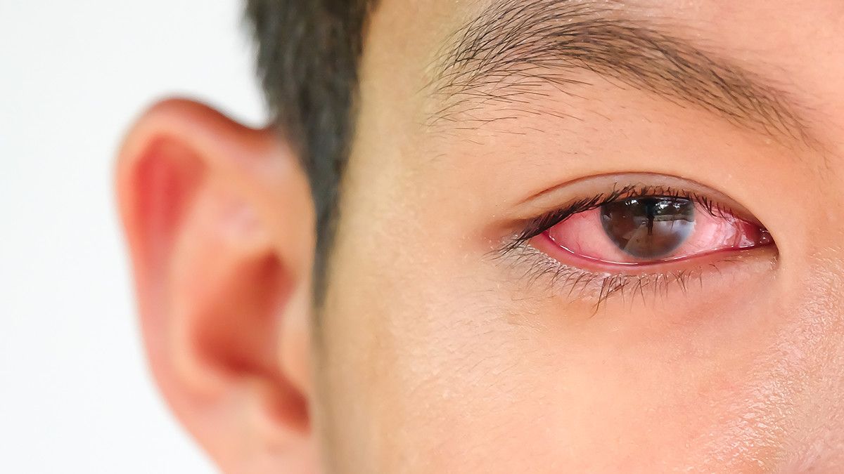 Apa Benar Mata Merah Pertanda Gejala Virus Corona? Ini Faktanya