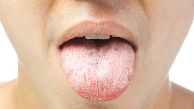 Papillomavirus langue chien - Papillomavirus et langue, Papillomavirus langue traitement