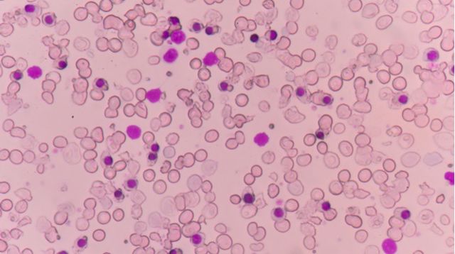 Thalassemia Tak Bisa Disembuhkan? (Toeytoey/Shutterstock)