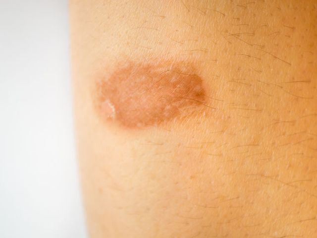 Luka bakar biasanya mengakibatkan titik-titik di bawah kulit