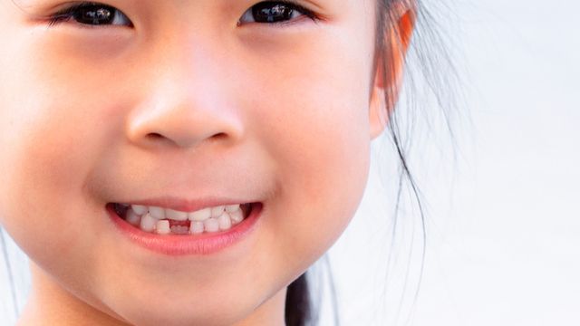 Cara menumbuhkan gigi gingsul di usia remaja