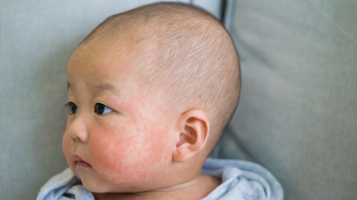 Alergi Susu Sapi Pada Bayi Asi