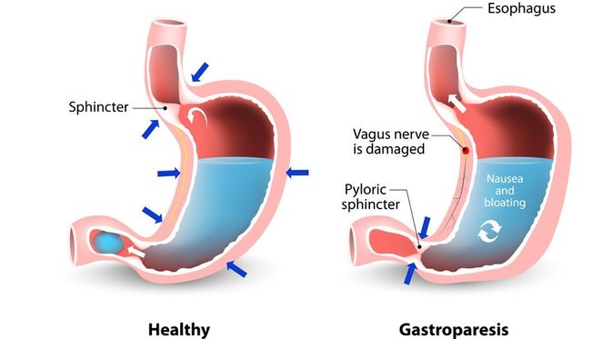 Penyakit Gastroparesis - KlikDokter.com (Designua/Shutterstock)