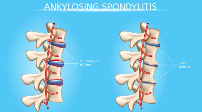 Penyakit Ankylosing Spondylitis