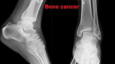 Kanker Tulang
