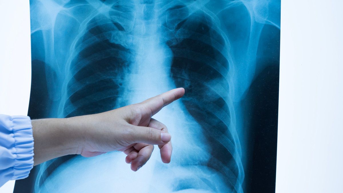 Penyakit paru-paru yang disebabkan oleh mycobacterium tuberculosis disebut