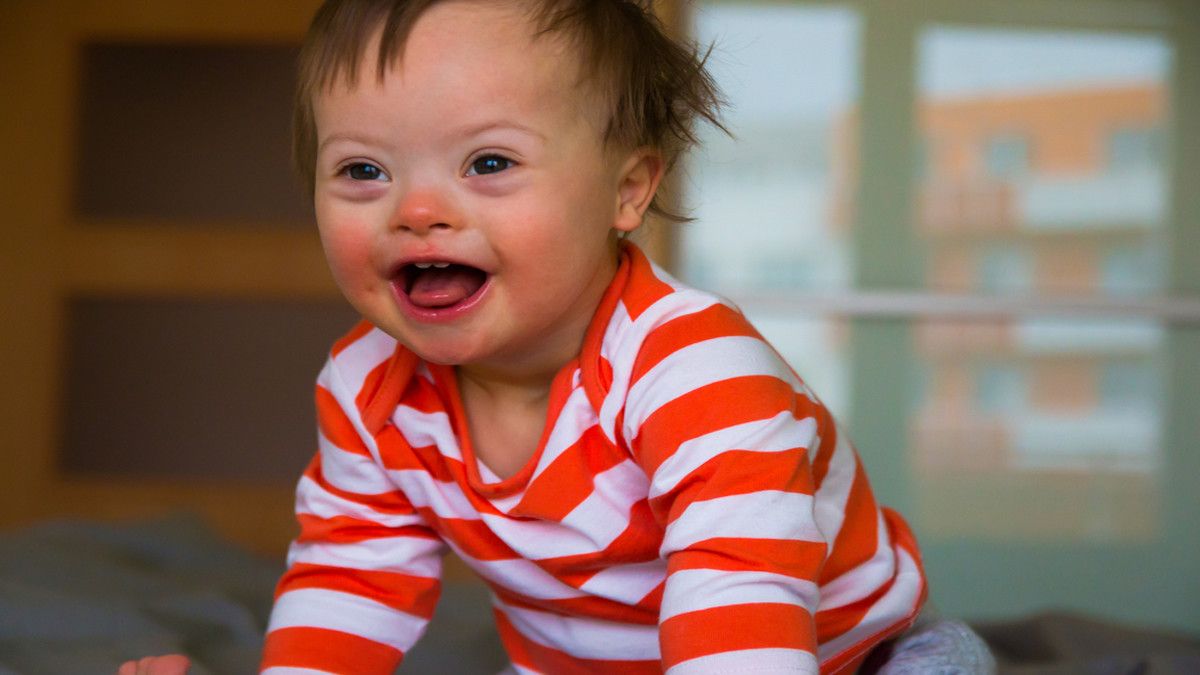 Hidung Bagian Atas Datar pada Bayi Down Syndrome