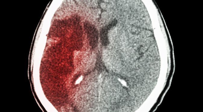 Penyakit Lumpuh Otak (Puwadol Jaturawutthichai/Shutterstock)