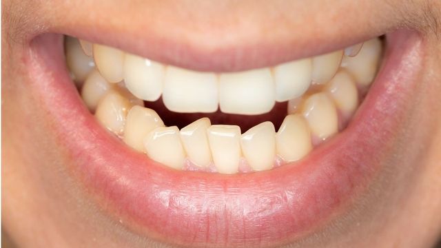 cara senyum untuk gigi tonggos