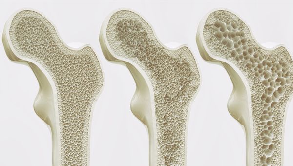 Osteoporosis dapat kita hindari dengan mengkonsumsi