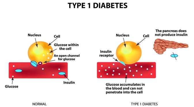 Penyakit Diabetes Juvenile (Timonina/Shutterstock)