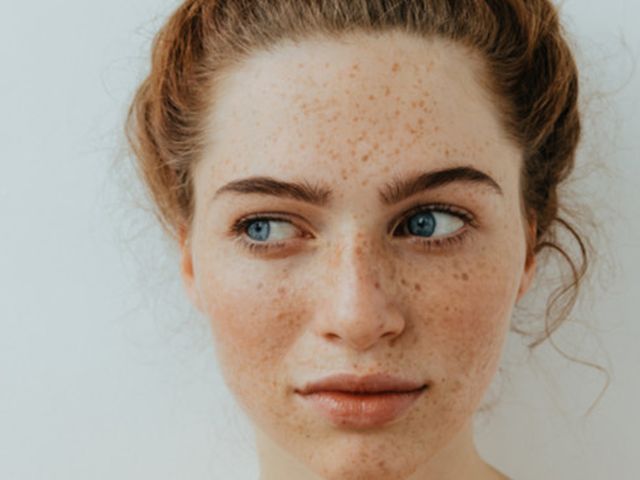 Mengulik Perbedaan Flek Hitam dan Freckles Serta Tips Mengatasinya 061091400 1558925126 Fakta tentang Freckles yang Perlu Anda Tahu By Jet Cat Studio Shutterstock