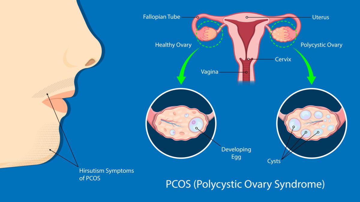 Sindrom ovarium polikistik