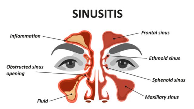 Apa Saja 4 Tanda Anda Mengalami Sinusitis?