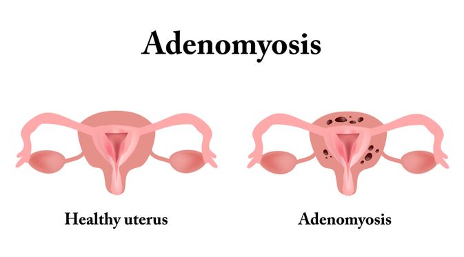Penyakit Adenomiosis