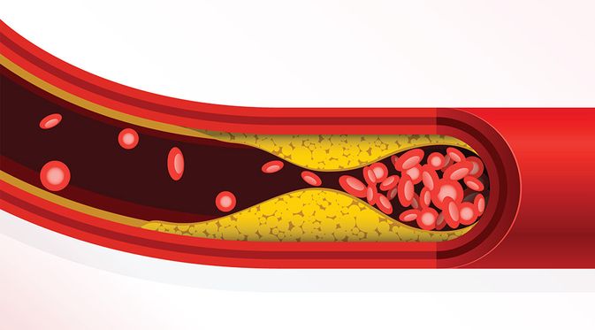 Hiperkolesterolemia -KlikDokter.com (GoMixer/Shutterstock)