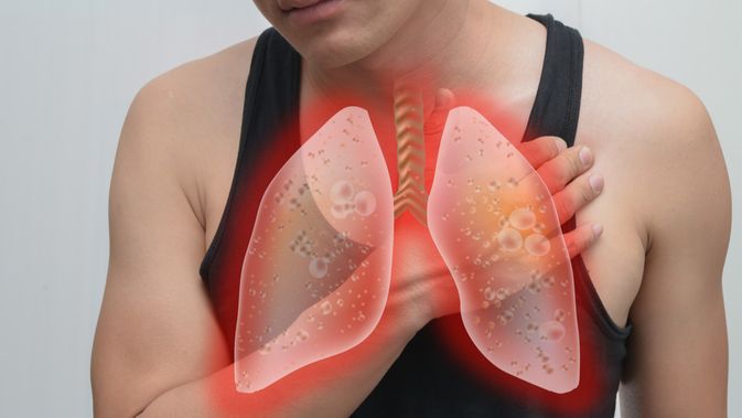 Dengan oleh atau yang penyakit dan paru-paru virus disebabkan terjadinya infeksi pada bakteri menyebabkan alveolus radang disebut Pneumonia