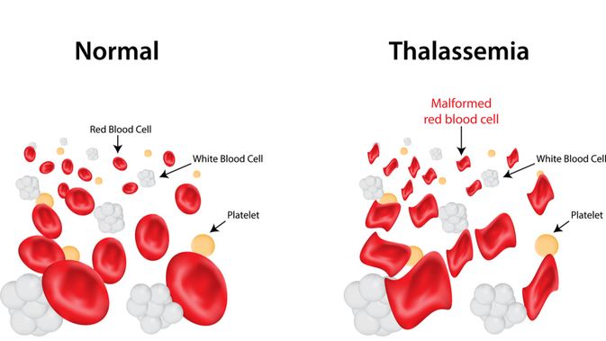 Thalasemia dengan disembuhkan penyakit bisa Cara Mengobatai