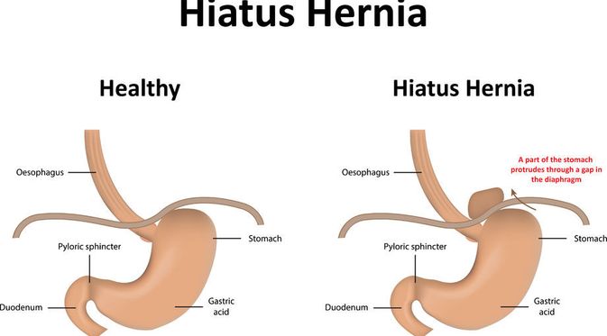 Adalah hernia Hiatus Hernia