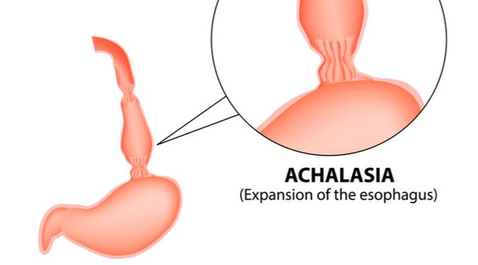 Penyakit Achalasia (Timonina/Shutterstock)