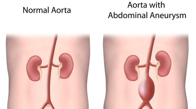 Penyakit Aneurisma Aorta Abdominalis (Alila Medical Media/Shutterstock)