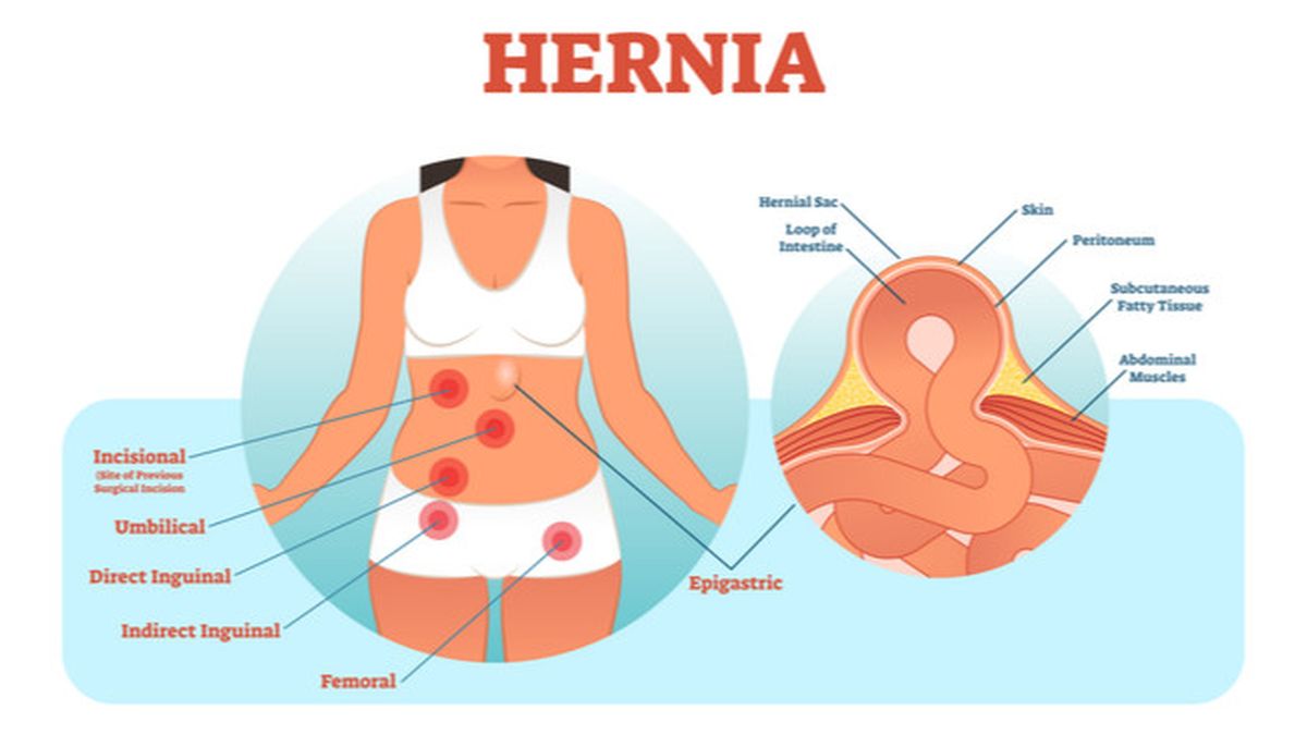 Penyebab Hernia Pada Wanita