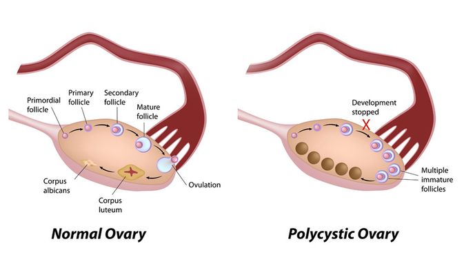 Sindrom ovarium polikistik