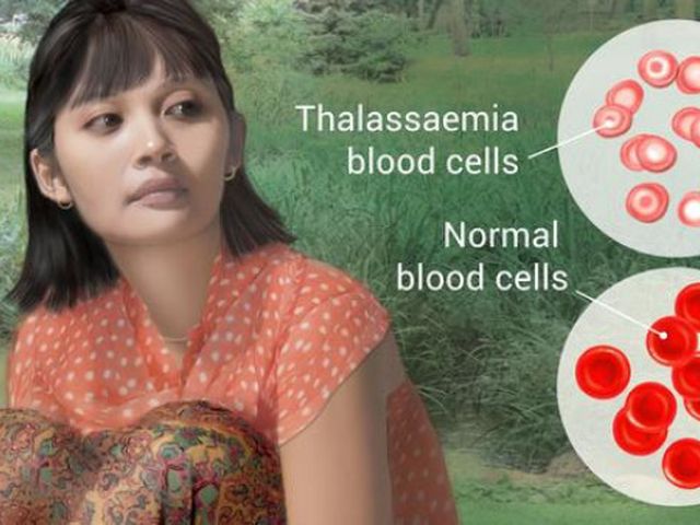 Thalassemia apakah Ciri