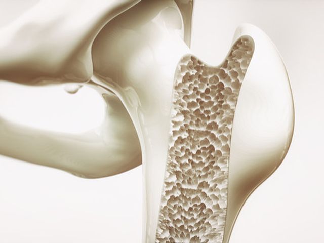 Osteoporosis dapat kita hindari dengan mengkonsumsi