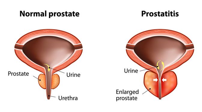 prostatic hyperplasia ( prostatita si cstalgii