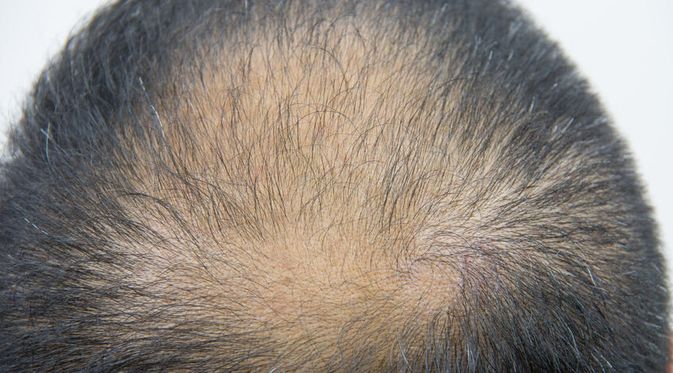 apa itu alopecia areata