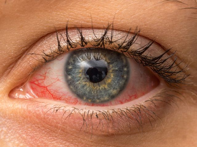 5 Penyebab Mata Merah yang Paling Sering, Apa Saja?
