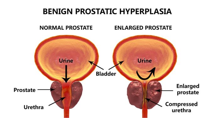prostata operatie laser)